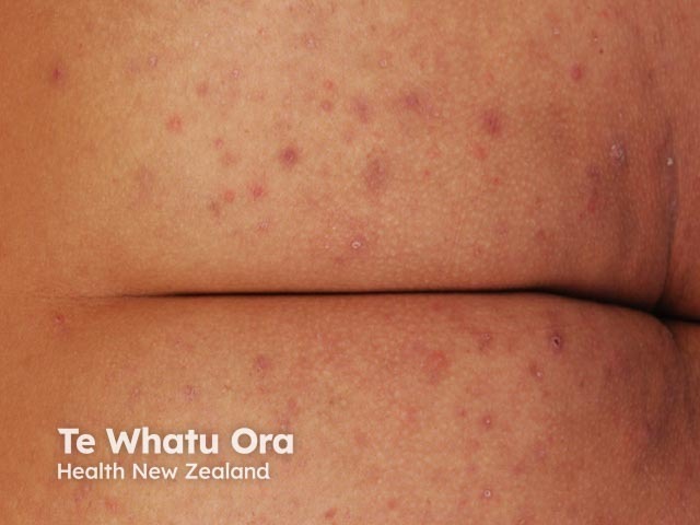 Hidradenitis suppurativa of buttocks