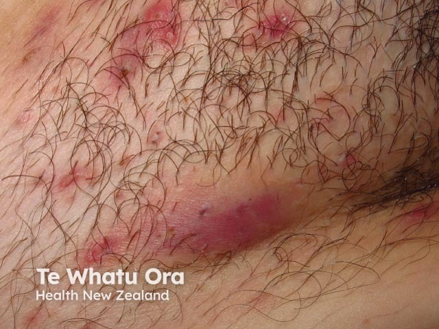 Inflammatory HS in the groin with multiple painful nodules