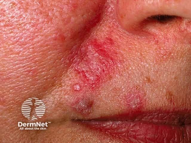 Cutaneous lupus erythematosus