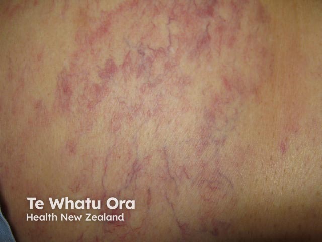 Intravascular lymphoma