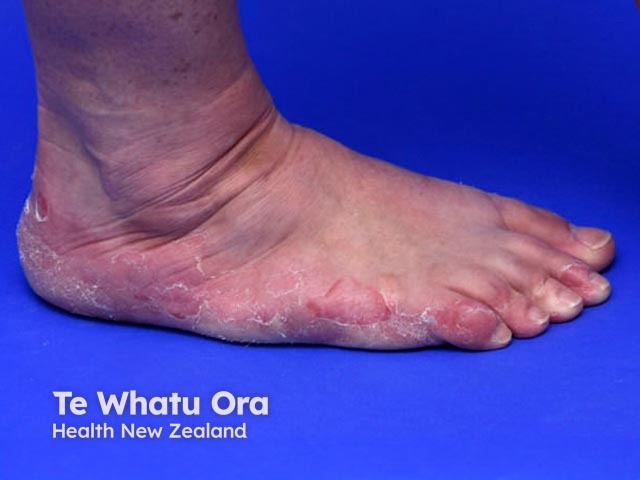 Keratolytic winter erythema