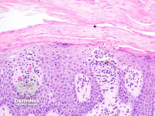 Keratosis lichenoides chronica figure 3