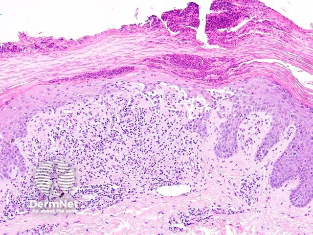 Keratosis lichenoides chronica figure 2