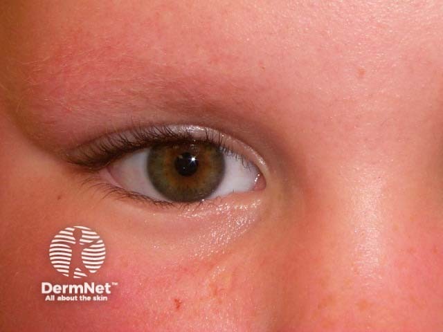 Keratosis pilaris faciei atrophicans