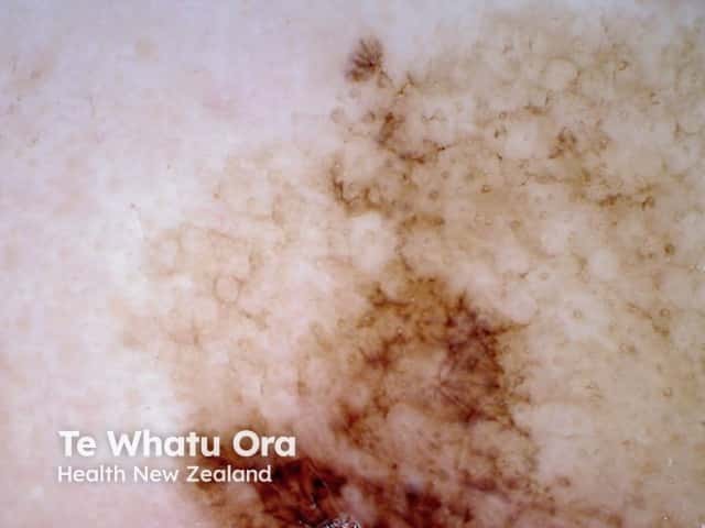 Asymmetrical pigmented follicular openings in lentigo maligna dermoscopy