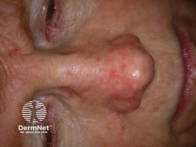 Actinic keratoses