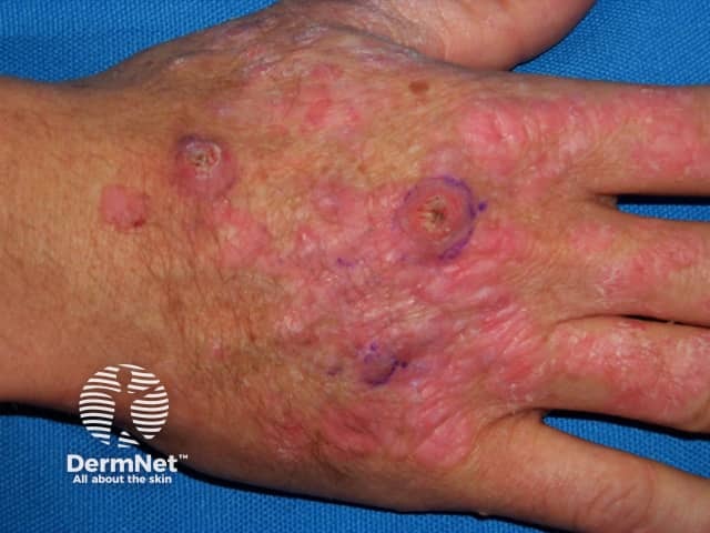 Actinic keratoses affecting the hands