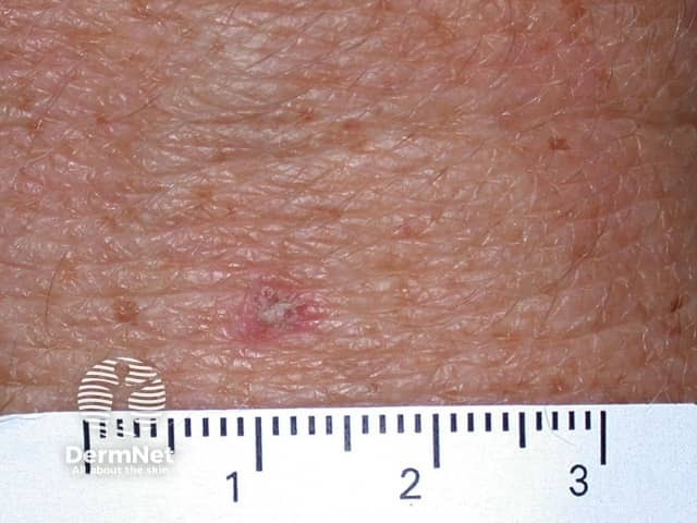 Actinic keratoses affecting the hands