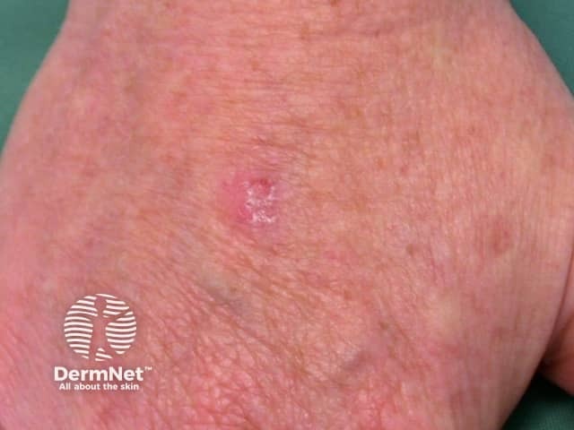 Actinic keratoses affecting the hands