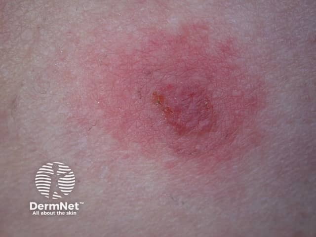 Basal cell carcinoma affecting the trunk