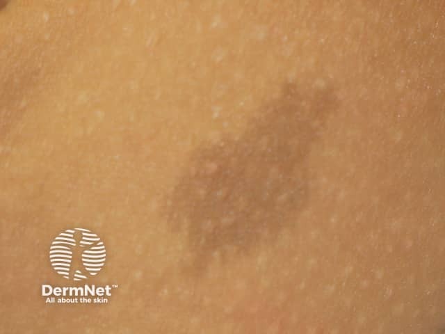 Café au lait macule