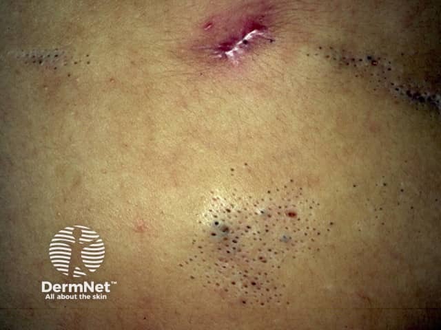 Comedo naevus