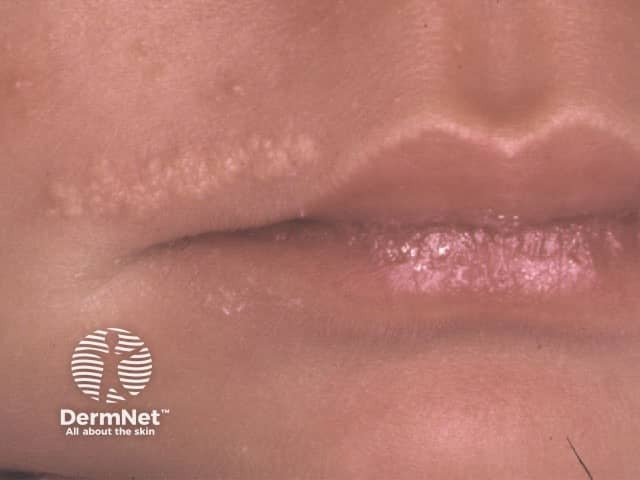 Connective tissue naevus