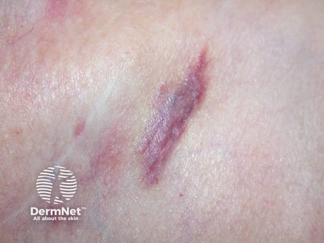 Metastatic breast cancer