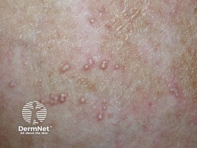 Following bullous pemphigoid