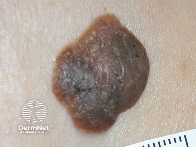 Seborrhoeic keratosis