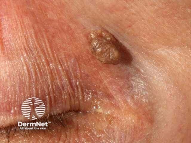 Seborrhoeic keratosis