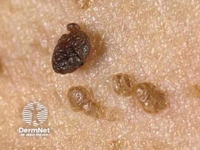 Seborrhoeic keratosis