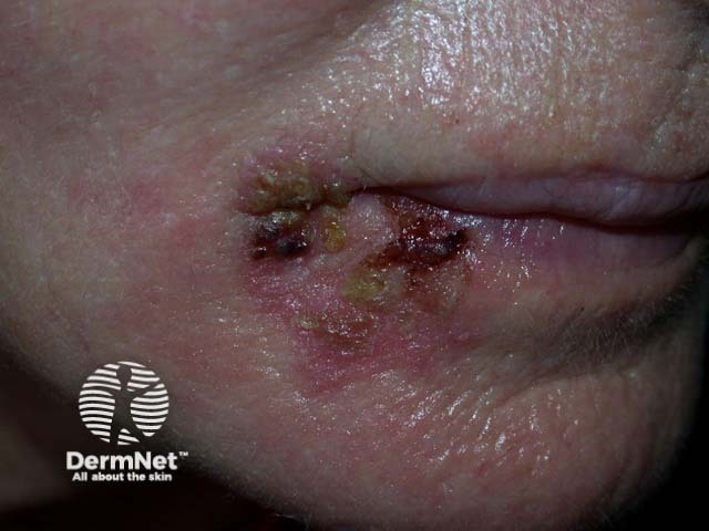 Intraepidermal carcinoma