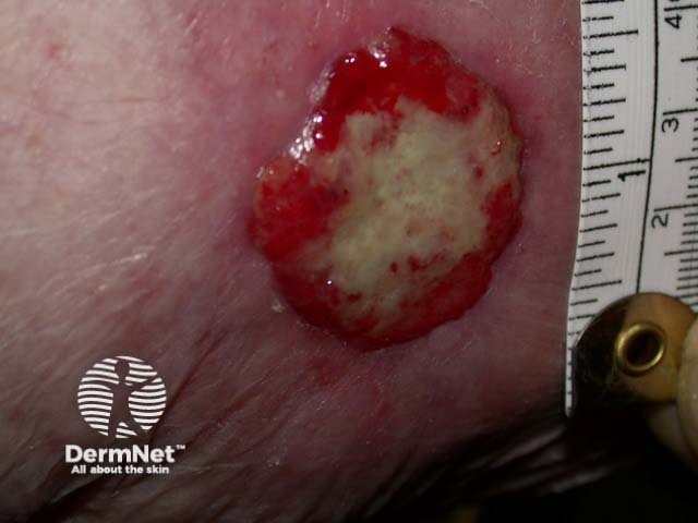 Squamous cell carcinoma of limbs