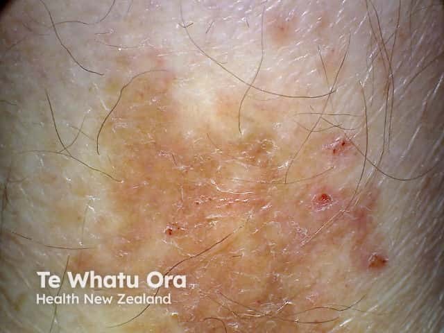 Lichen aureus - right shin