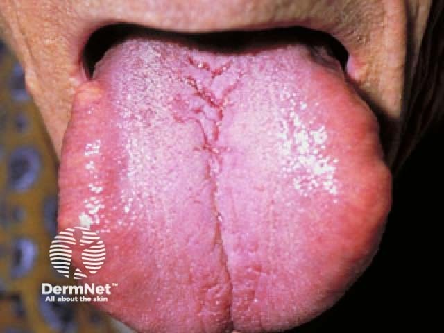 Macroglossia in systemic amyloidosis