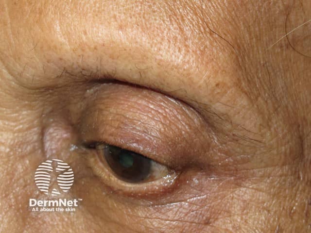 Frontal fibrosing alopecia