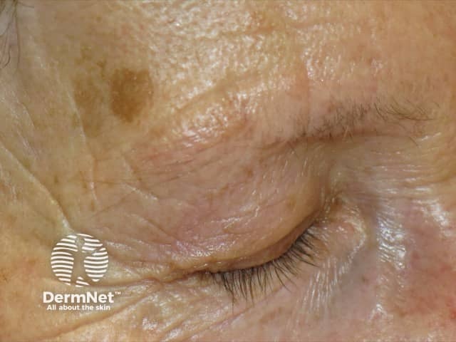 Frontal fibrosing alopecia