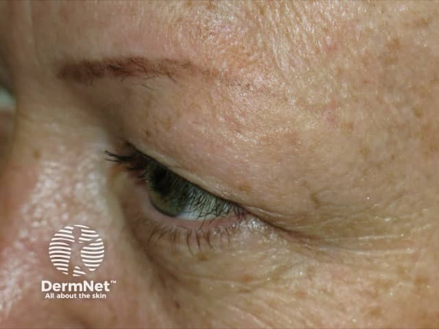 Frontal fibrosing alopecia