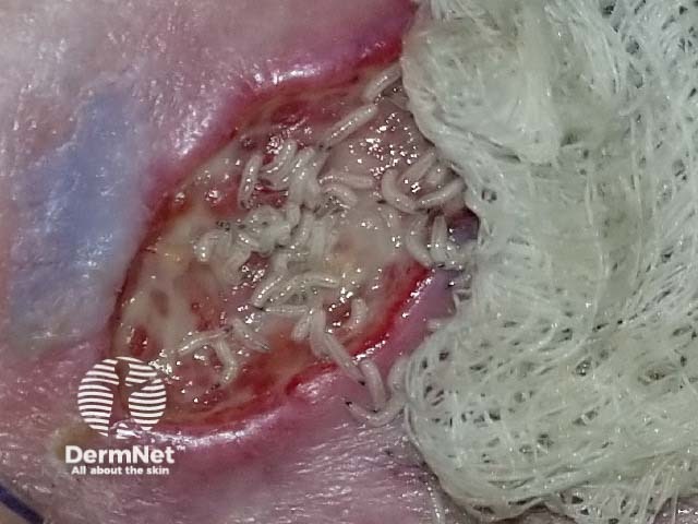 Maggot therapy of chronic leg ulcer