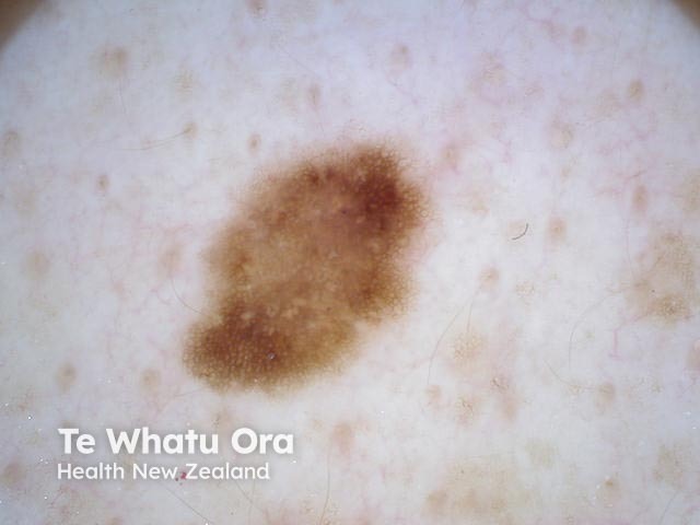 Melanocytic naevus, nonpolarised dermoscopy view