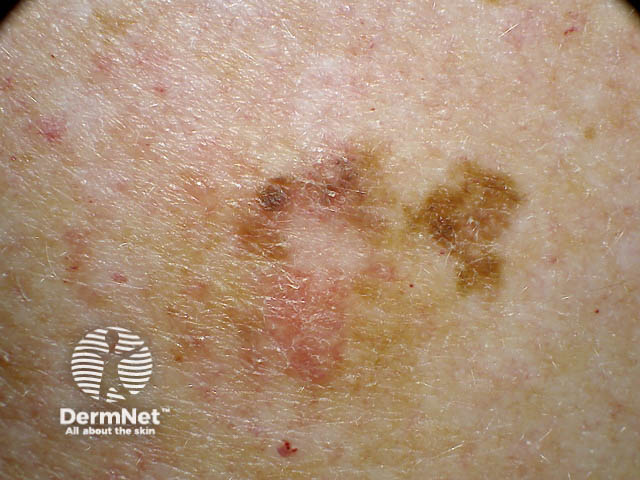 Lentiginous melanoma