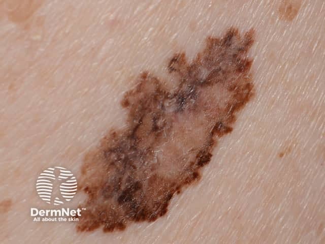 Macro image of superficial spreading melanoma 4