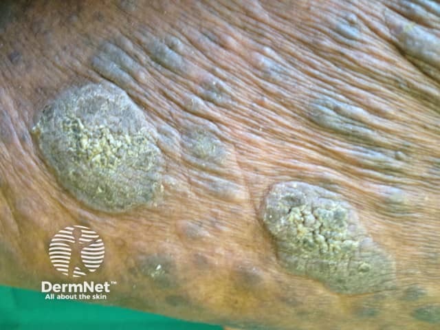 Tumour stage mycosis fungoides