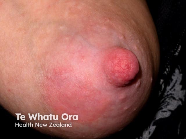 Montgomery tubercles and eczema