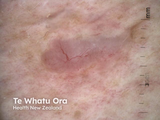 Nodular basal cell carcinoma dermoscopy