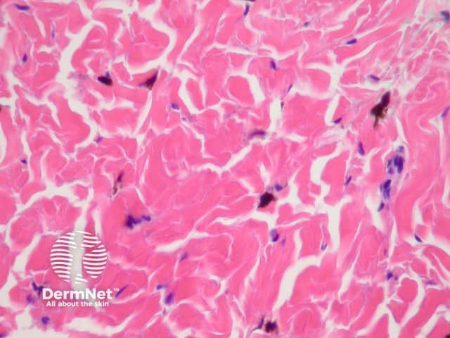 Histopathology of dermal dendritic melanocytes that make up a common blue naevus