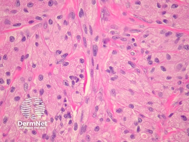 High power histopathology - demonstrates fine granularity of the tumour cytoplasm