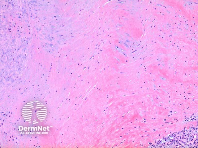 Myofibroma pathology