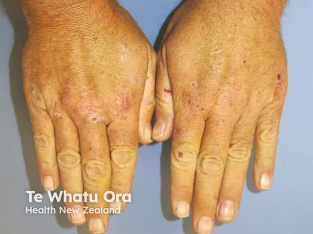 Porphyria cutanea tarda