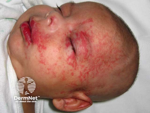 Segmental infantile haemangioma