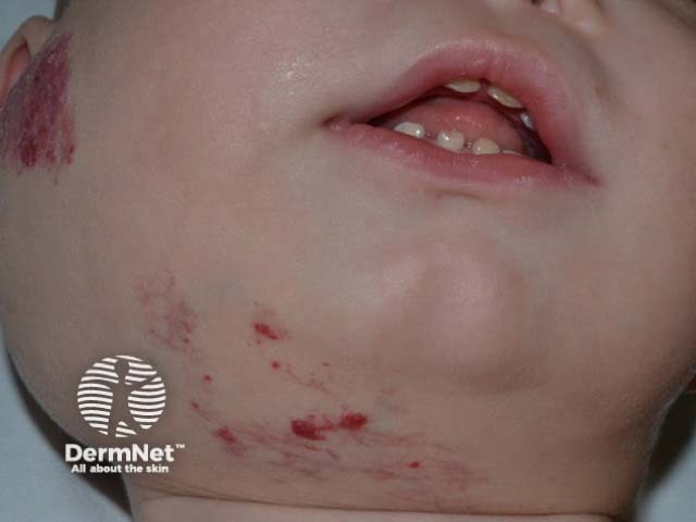 Cervicofacial infantile haemangioma