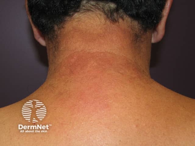 Drug-induced photosensitivity