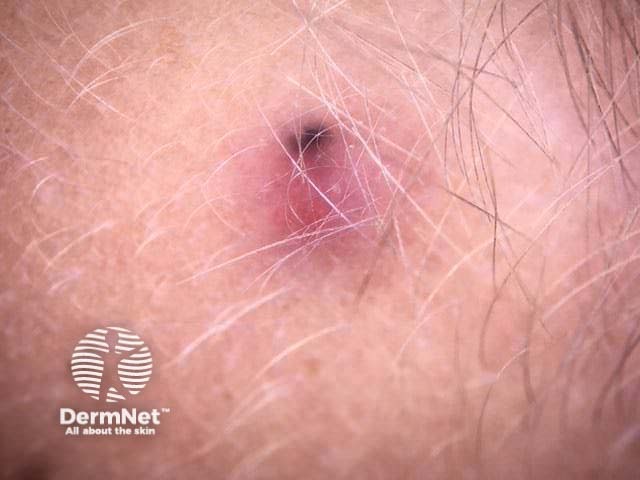 Pilomatricoma dermoscopy