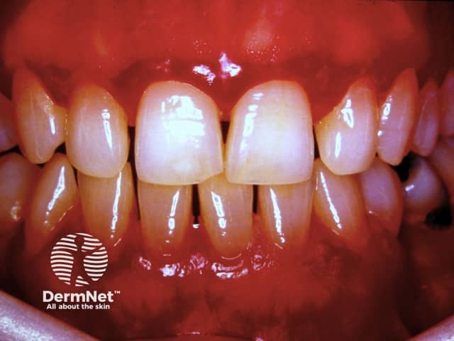 Cutaneous adverse reaction to anticonvulsant, gingival hyperplasia