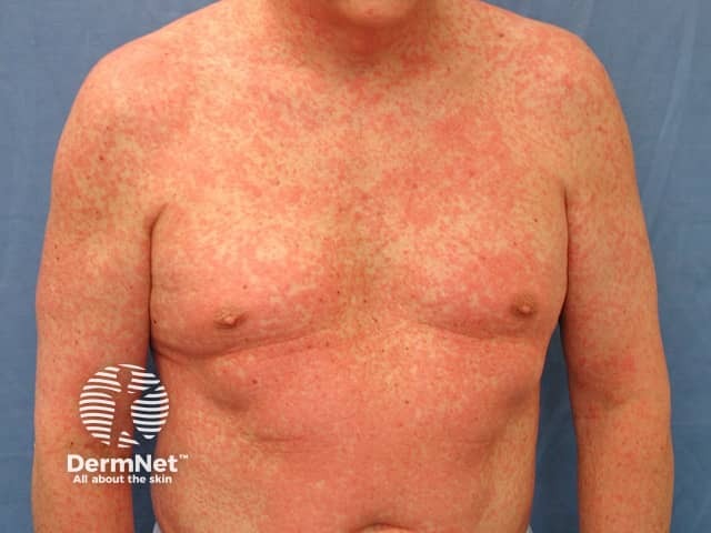 Morbilliform drug eruption