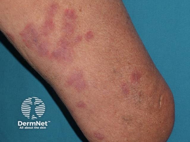 Acute febrile neutrophilic dermatosis