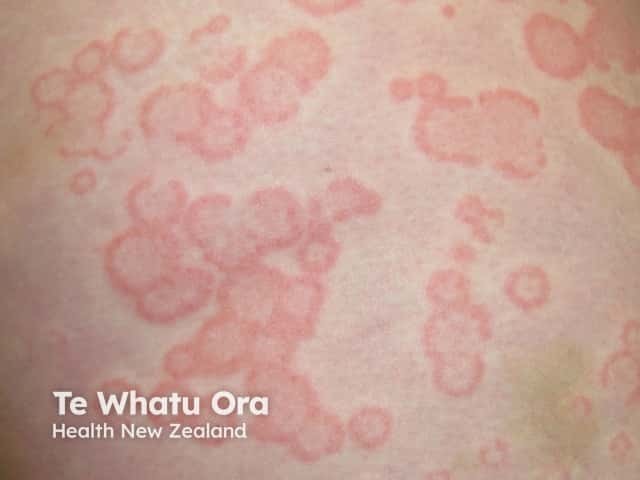 Urticaria