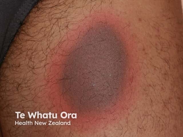 Targetoid lesion in fixed drug eruption