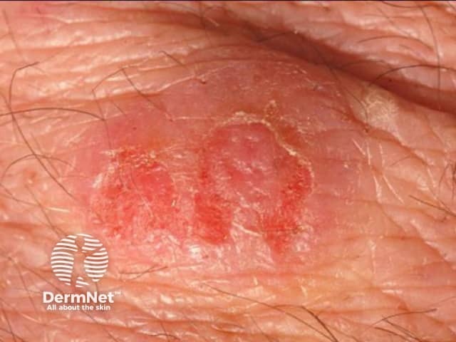 Eosinophilic cellulitis